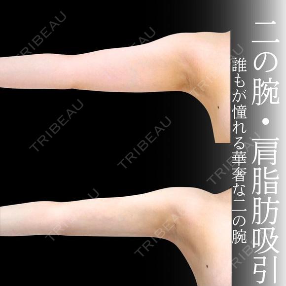 二の腕　肩　脂肪吸引 after画像 メイン用