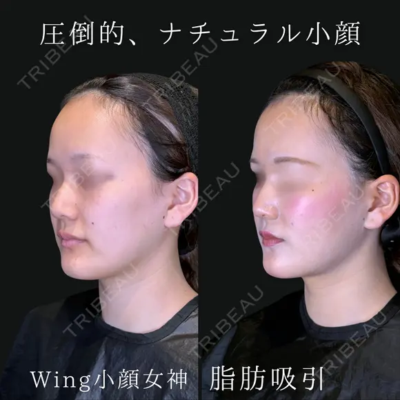 Wing小顔女神脂肪吸引 before画像 メイン用