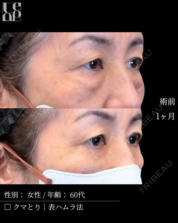 表ハムラ before画像 メイン用