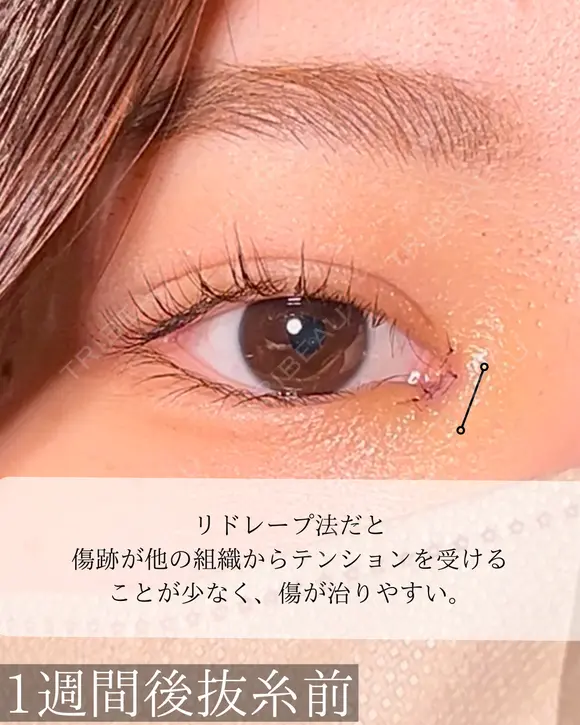 目頭切開 after画像 メイン用