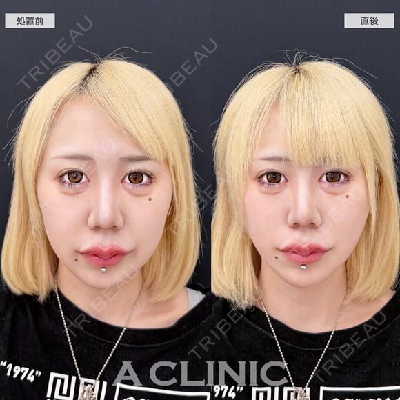 【Aスレッド(繊維)】Aスレッドでもたつきをグイっと引き上げて超シャープなフェイスラインに！こちら処置前と直後の症例です after画像 メイン用