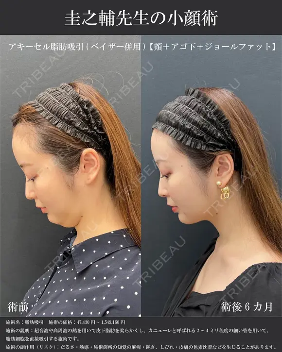 アキーセル脂肪吸引ベイザー併用(頬顎下ジョールファット)＋糸リフト before画像 メイン用