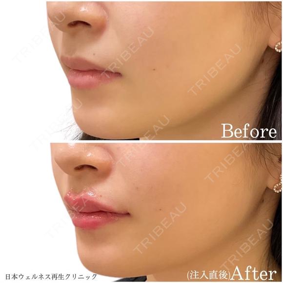唇　ヒアルロン酸 after画像 メイン用