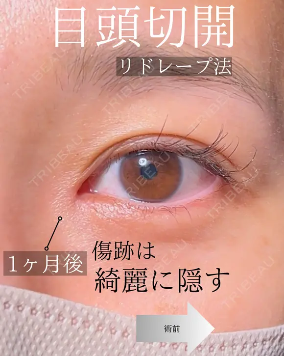 目頭切開 after画像 メイン用