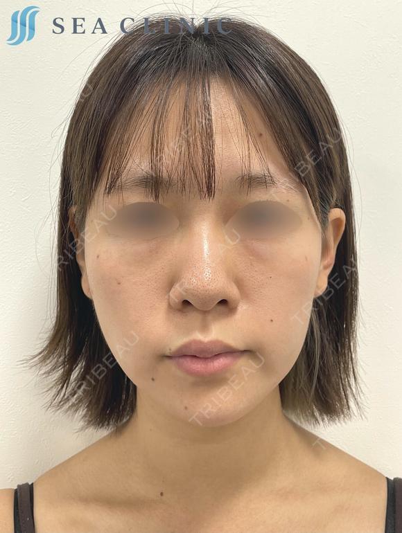 SEAライン ‐３D脂肪吸引（頬・顎）‐・ジョールファット・糸リフト・目の下のクマ取り・脂肪注入(目の下) before画像 メイン用