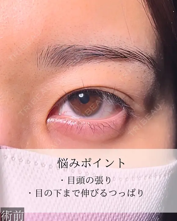 目頭切開 before画像 メイン用