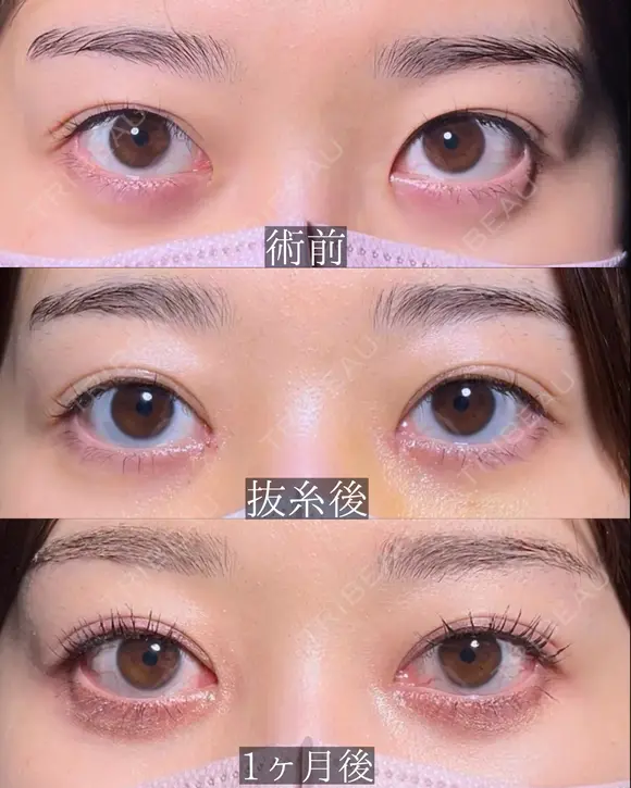 目頭切開 after画像 メイン用