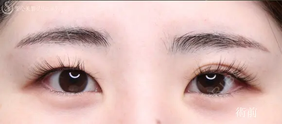 【20代女性・MIX二重で目元をぱっちり】二重術（埋没法）：マイクロメソッド+α（術後2ヶ月） before画像 メイン用