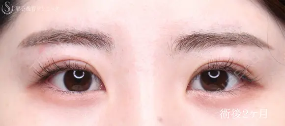 【20代女性・MIX二重で目元をぱっちり】二重術（埋没法）：マイクロメソッド+α（術後2ヶ月） 60日後 メイン用