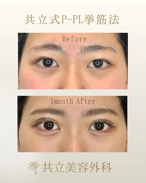 共立式二重埋没P-PL挙筋法 before画像 メイン用