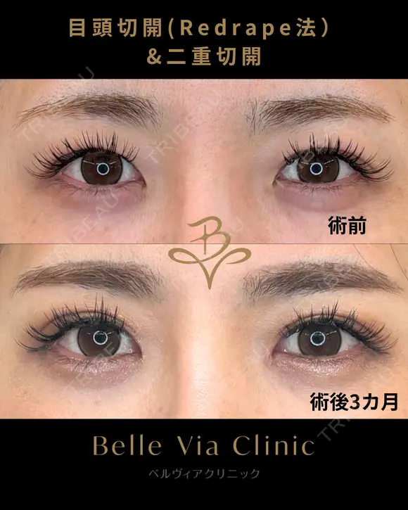 目頭切開+二重切開 before画像 メイン用