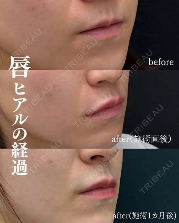 唇のヒアルロン酸　ボルベラ0.75cc before画像 メイン用