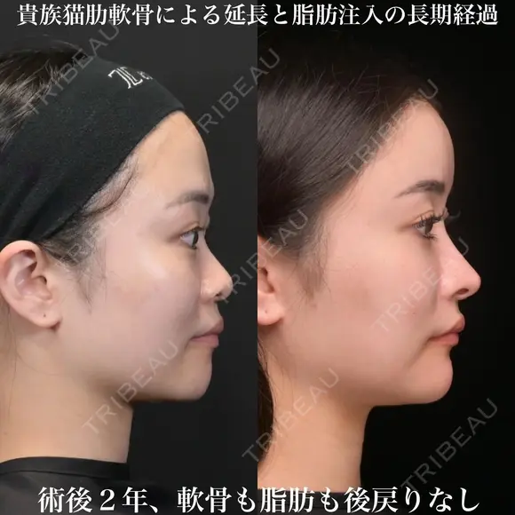 術後2年、軟骨も脂肪も後戻りなし！貴族猫肋軟骨による延長と脂肪注入の長期経過 730日後 メイン用