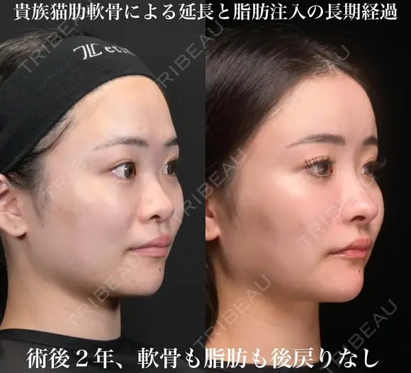 術後2年、軟骨も脂肪も後戻りなし！貴族猫肋軟骨による延長と脂肪注入の長期経過 730日後 メイン用