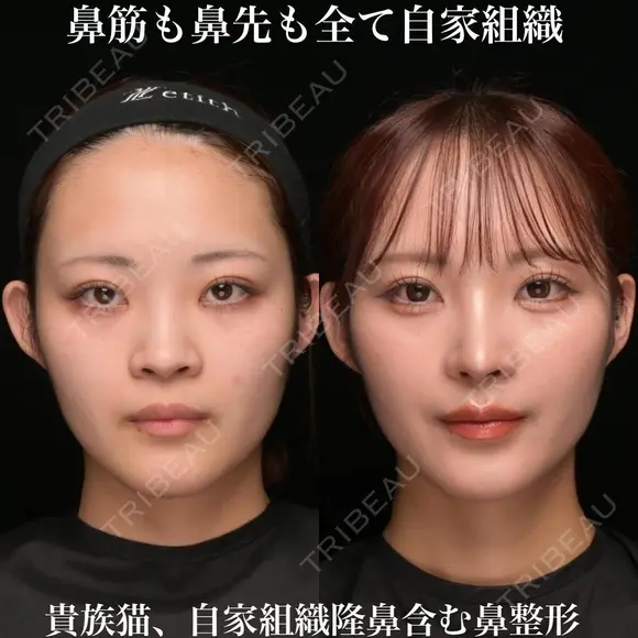 鼻筋も鼻先も全て自家組織/貴族猫、自家組織隆鼻含む鼻整形 before画像 メイン用