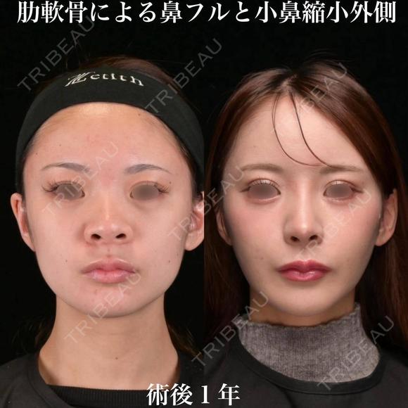 肋軟骨による鼻フルと小鼻縮小外側 365日後 メイン用