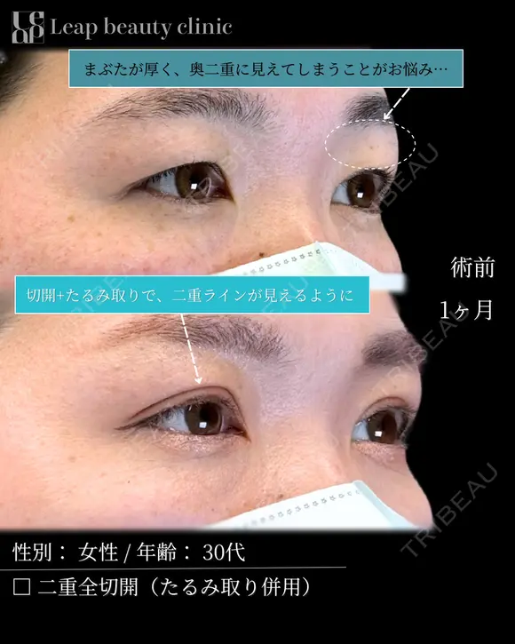 二重全切開(たるみとり併用) 30日後 メイン用