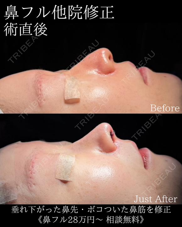 他院修正鼻フル before画像 メイン用