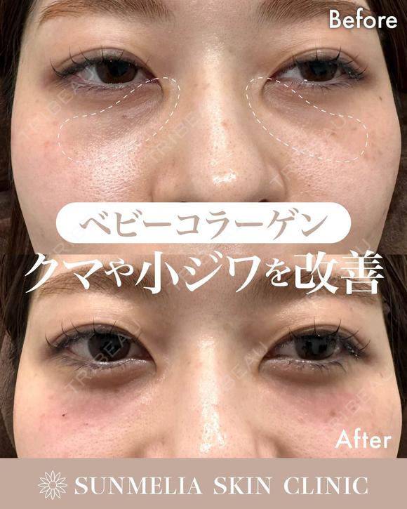 ベビーコラーゲン after画像 メイン用