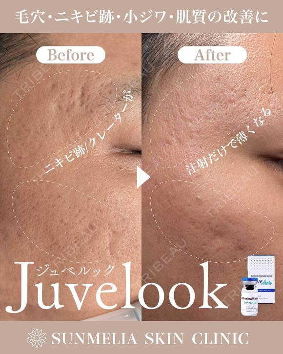 ジュベルック before画像 メイン用