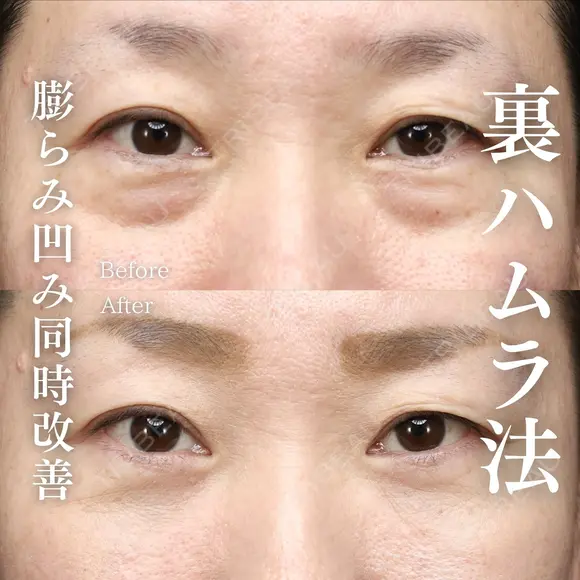 切らないクマ取り(裏ハムラ法) 30日後 メイン用