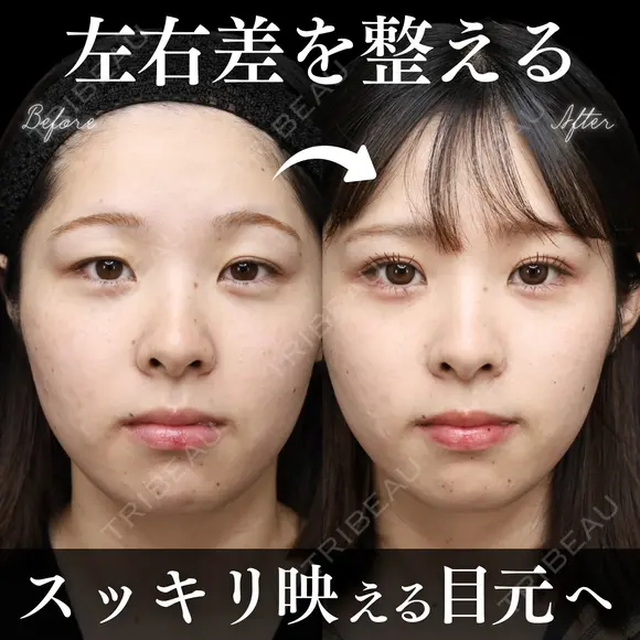 二重埋没法＋まぶたの脂肪取り before画像 メイン用