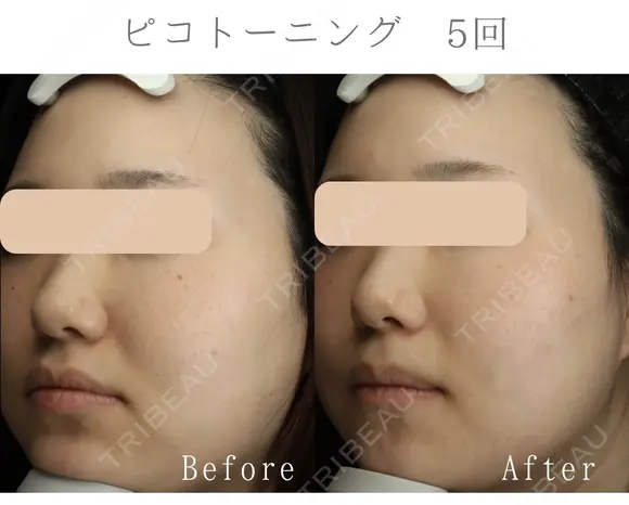 ピコトーニング before画像 メイン用