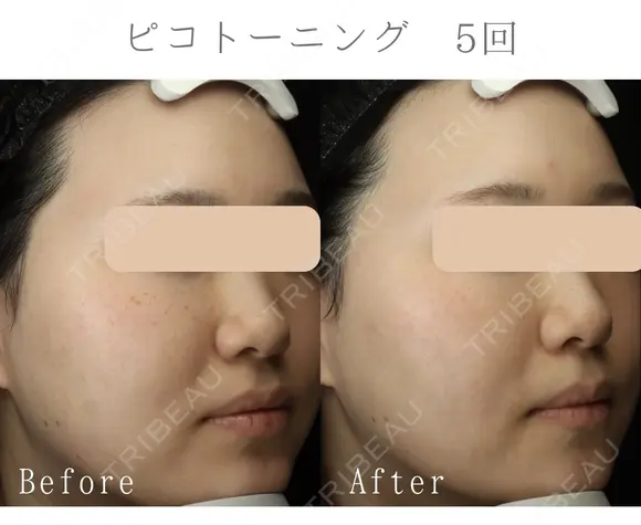 ピコトーニング after画像 メイン用
