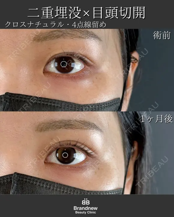 二重埋没（クロスナチュラル・４点線留め）＋目頭切開 before画像 メイン用