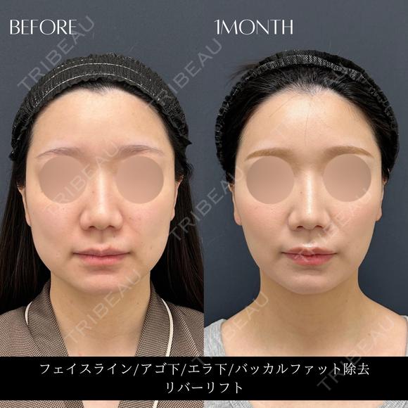 リバー式小顔脂肪吸引 before画像 メイン用