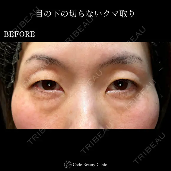目の下の切らないクマ取り before画像 メイン用