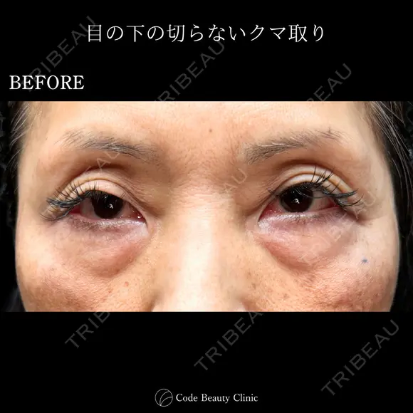 目の下の切らないクマ取り before画像 メイン用