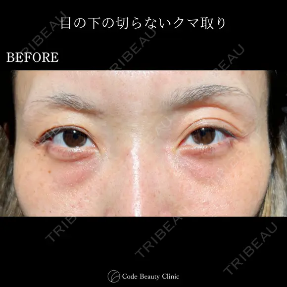 目の下の切らないクマ取り before画像 メイン用