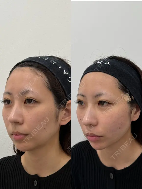 糸リフト before画像 メイン用
