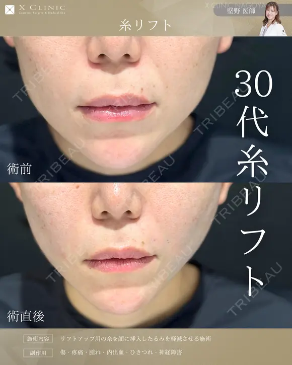 糸リフト after画像 メイン用