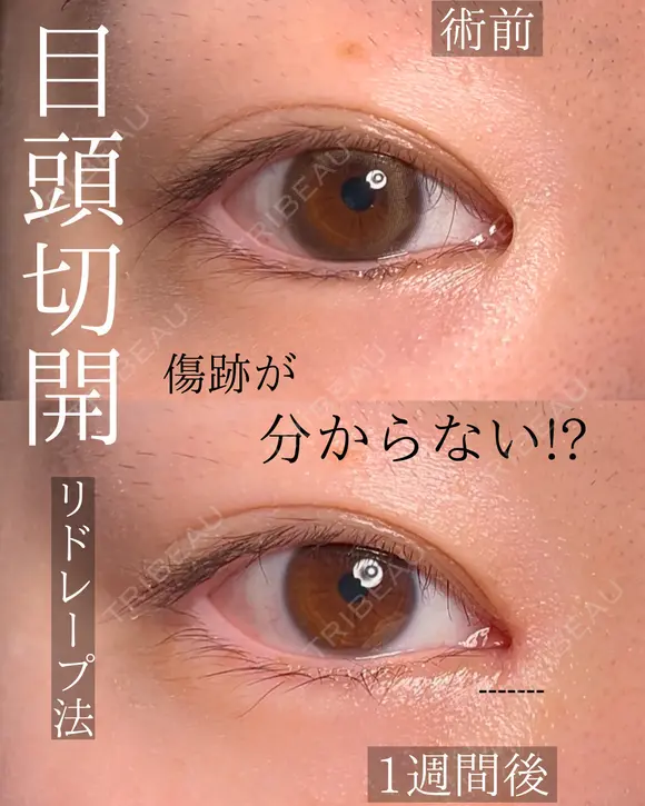 目頭切開 after画像 メイン用