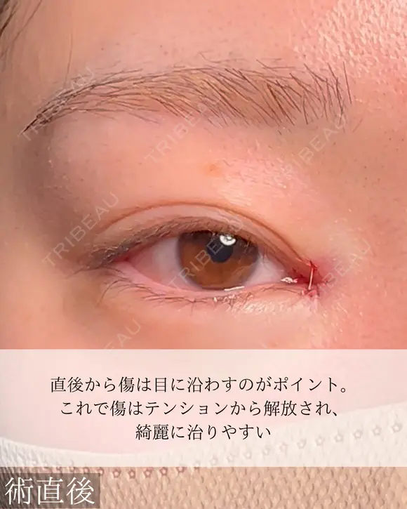 目頭切開 after画像 メイン用