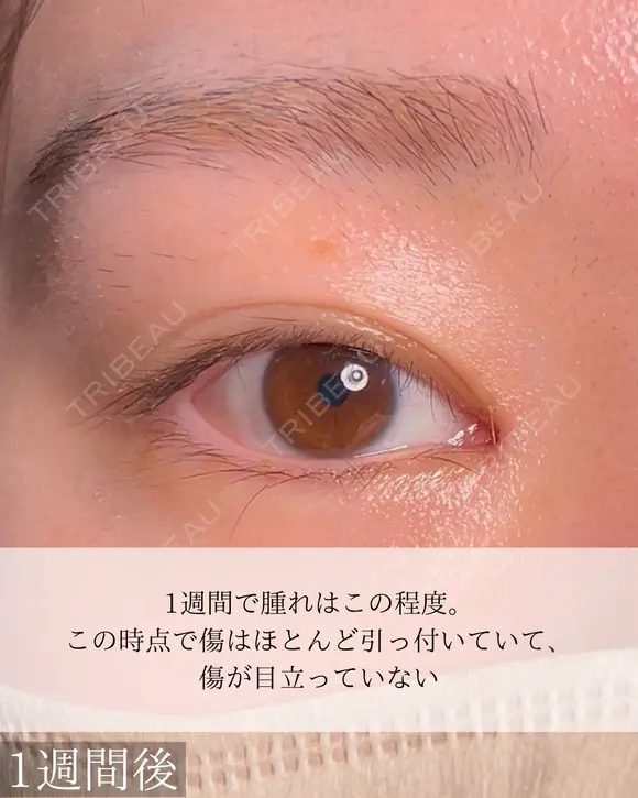 目頭切開 after画像 メイン用