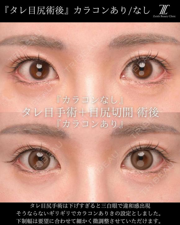 タレ目手術の症例紹介です。 before画像 メイン用