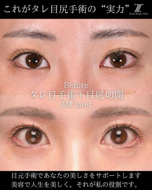 タレ目手術の症例紹介です。 90日後 メイン用