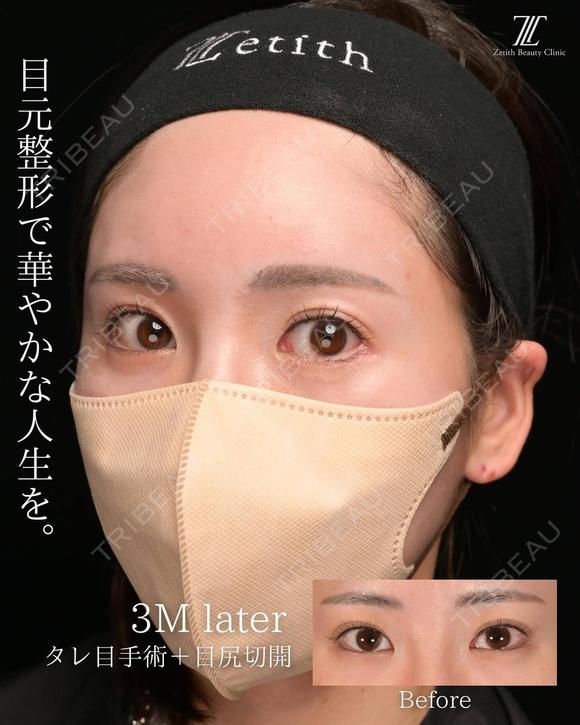 タレ目手術の症例紹介です。 90日後 メイン用