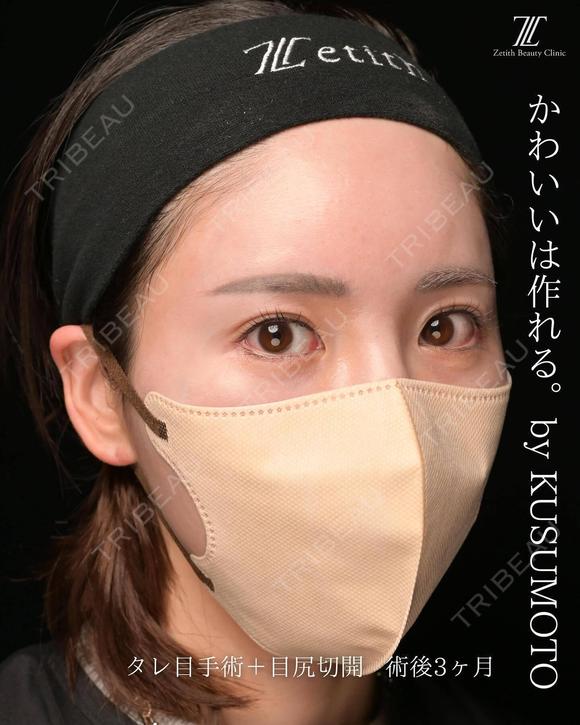 タレ目手術の症例紹介です。 90日後 メイン用