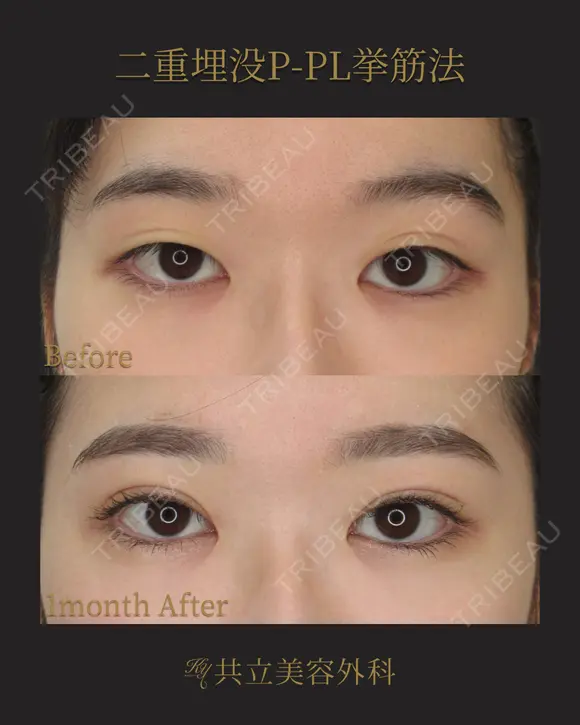 共立式二重埋没P-PL挙筋法 before画像 メイン用