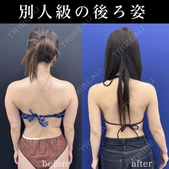 シークレット脂肪吸引二の腕 30日後 メイン用
