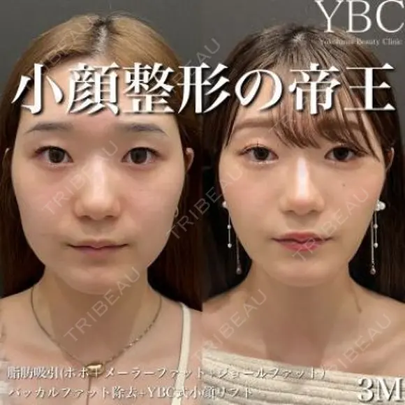 【🦒1dayVライン3D脂肪吸引🦒】 after画像 メイン用