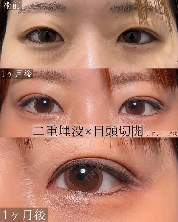 目頭切開 二重埋没 30日後 メイン用