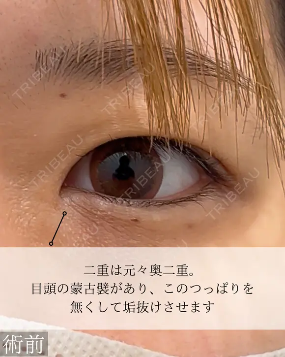 目頭切開 二重埋没 before画像 メイン用