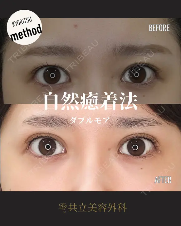 自然癒着法 before画像 メイン用