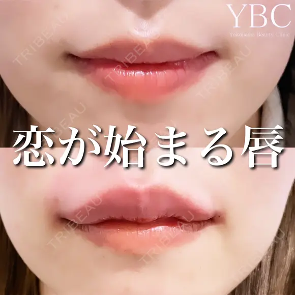 【ヒアルロン酸注入で恋が始まる唇💖】 before画像 メイン用