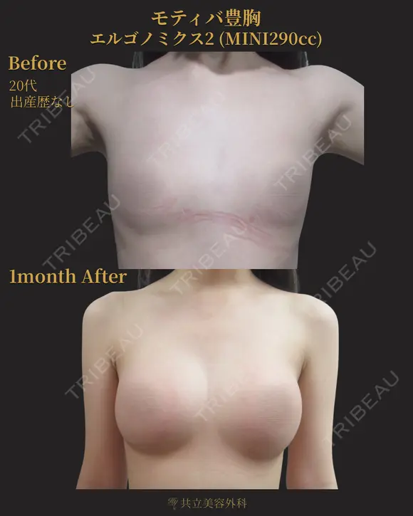 バック豊胸｜モティバ エルゴノミックス(エルゴノミックスタイプ) before画像 メイン用